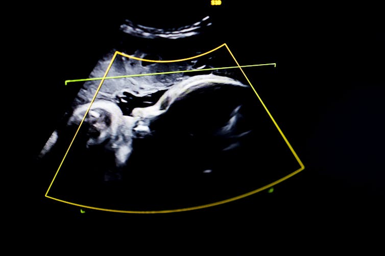  Pregnancy is an engineering challenge − diagnosing and treating preterm birth requires understanding its mechanics